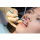 Lunos Fluoride gel application braces
