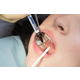 Lunos Fissure sealant application