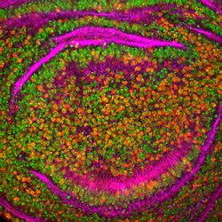Drosophila Wing Cells. The human CBFA2T3-GLIS2 fusion protein is a key driver of pediatric acute megakaryoblastic leukemia (AMKL), and confers a poor prognosis. Researchers found a way to express CBFA2T3-GLIS2 (red) in larval Drosophila (fruit fly) wing disc cells, confirming a major role for the BMP signaling pathway. This pathway may provide a target for new therapies. Nuclei (green) and actin 