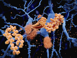 Alzheimer's disease: the amyloid-beta peptide accumulates to amyloid fibrils that build up dense amyloid plaques. 3d rendering

