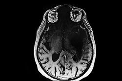 CAT - Scan image of brain tumor