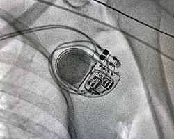 X ray image during permanent pacemaker implantation procedure