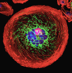 Breast cancer: polyploid giant cancer cell (PGCC)