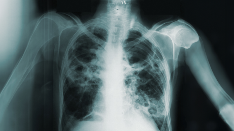 Frontiers in Tuberculosis