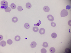 Plasmodium falciparum gametocyte in blood smear.