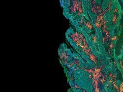 The edge of a tumour where the levels of different proteins has been probed for using antibodies labelled with fluorophores