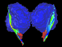 Connections between the substancia nigra and the thalamus in a Parkinson's brain