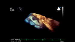 3D image of the heart during transesophageal ultrasound.