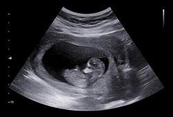 Ultrasound small baby at 12 weeks. 12 weeks pregnant ultrasound image show baby or fetus development and pregnancy health checking.