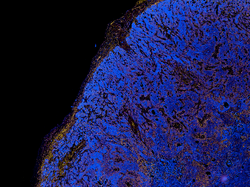 Research sample slide of tumor tissue where cells have been stained for different proteins using a fluorescently tagged antibody. Presented as false color image on white background.