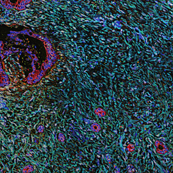 Pancreatic Desmoplasia